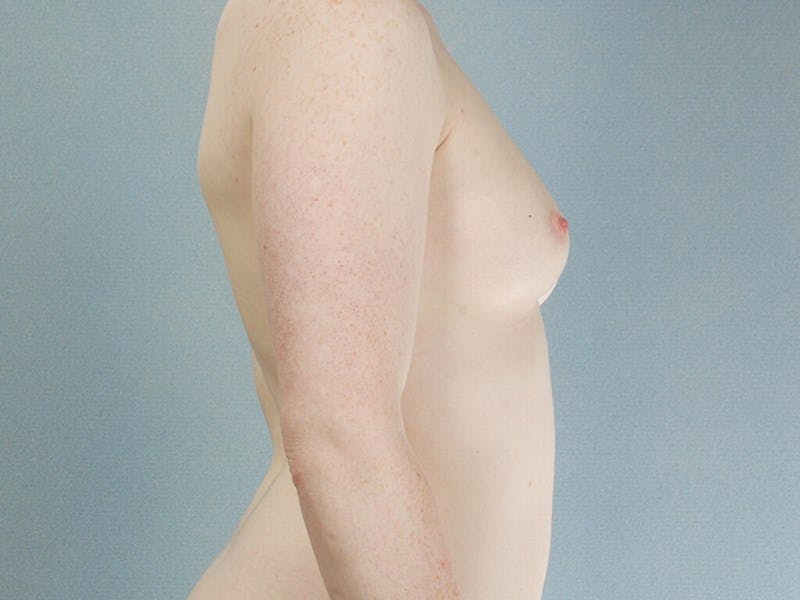 Breast Augmentation Before & After Gallery - Patient 369542 - Image 5