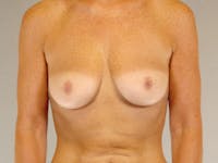 Breast Augmentation Before & After Gallery - Patient 363165 - Image 1