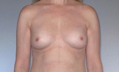 Breast Augmentation Before & After Gallery - Patient 218806 - Image 1