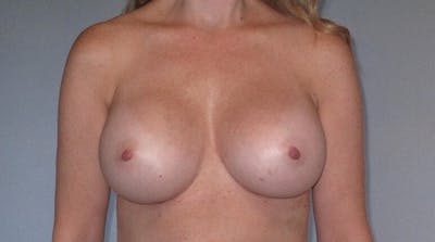 Breast Augmentation Before & After Gallery - Patient 218806 - Image 2