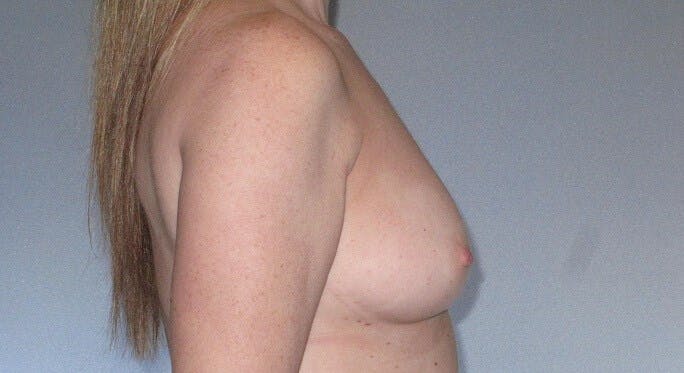 Breast Augmentation Before & After Gallery - Patient 218806 - Image 5