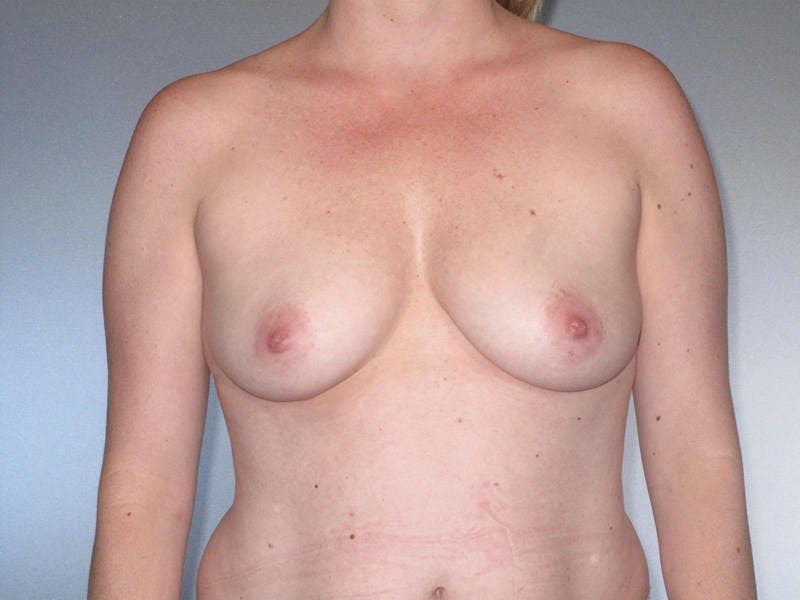 Breast Augmentation Before & After Gallery - Patient 954443 - Image 3