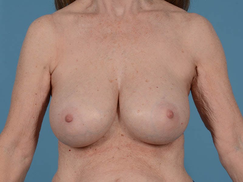 Breast Augmentation Before & After Gallery - Patient 187653 - Image 2