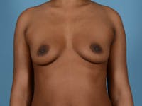 Breast Augmentation Before & After Gallery - Patient 275629 - Image 1
