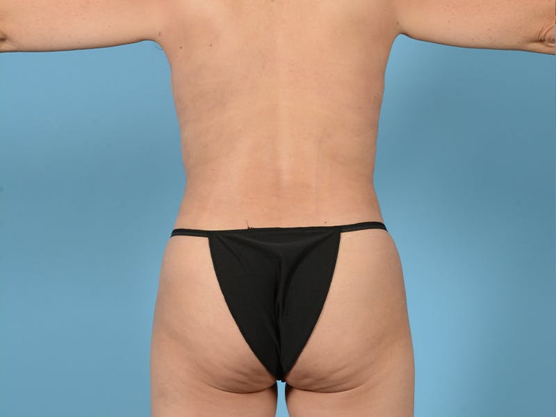 Breast Augmentation Before & After Gallery - Patient 283233 - Image 8