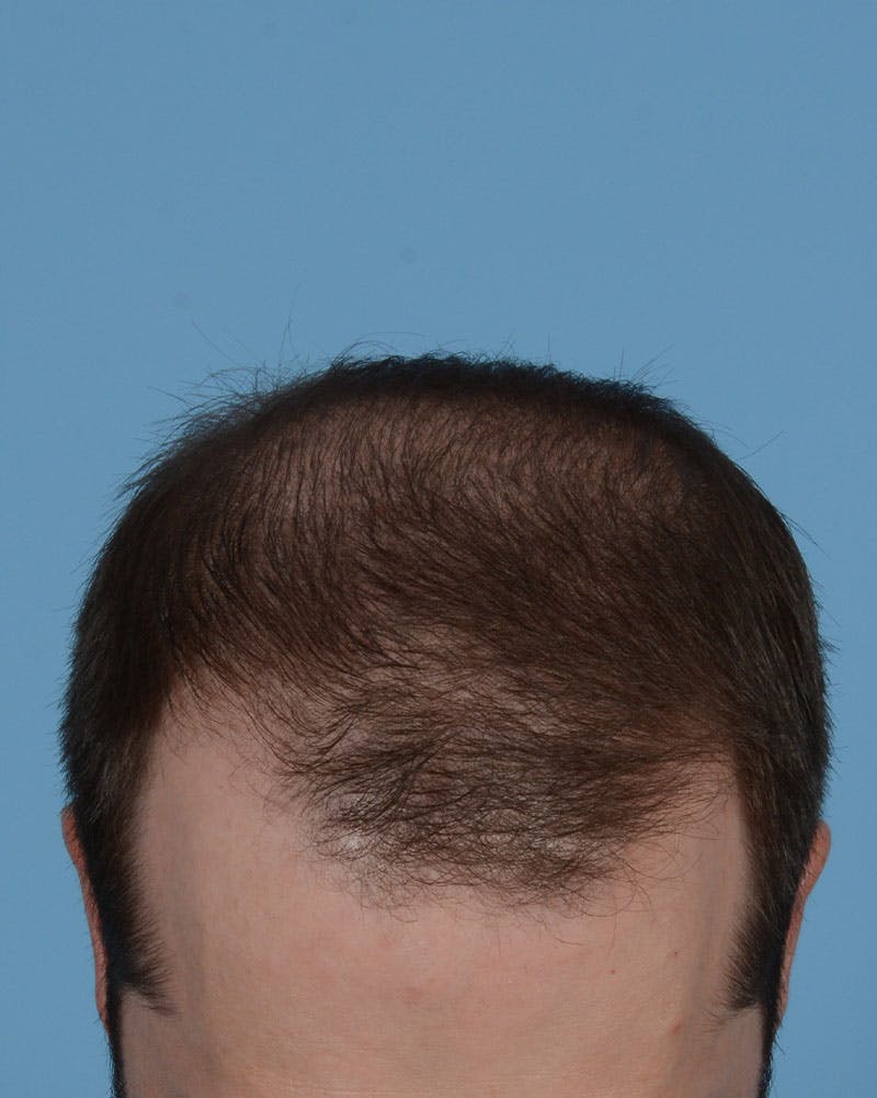 Hair Transplant Before & After Gallery - Patient 158386 - Image 1