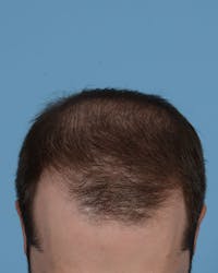 Hair Transplant Before & After Gallery - Patient 158386 - Image 1