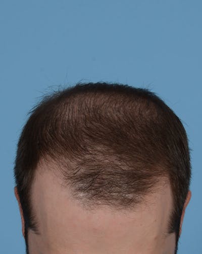 Hair Transplant Before & After Gallery - Patient 158386 - Image 1