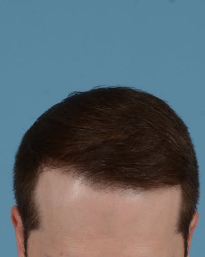 Hair Transplant Before & After Gallery - Patient 158386 - Image 2