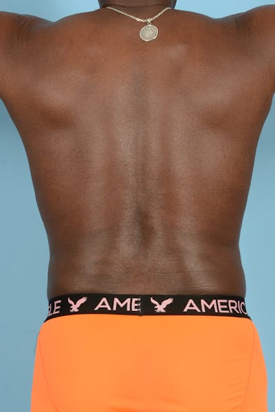 Abdominal Etching Before & After Gallery - Patient 121462 - Image 10