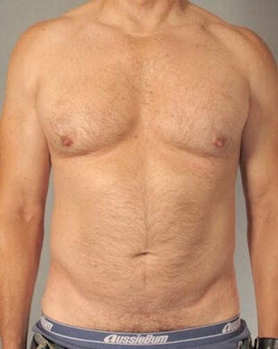 Abdominal Etching Before & After Gallery - Patient 413884 - Image 1