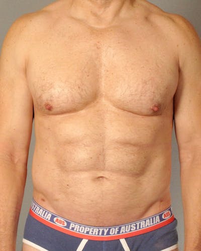 Abdominal Etching Before & After Gallery - Patient 413884 - Image 2