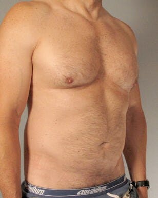 Abdominal Etching Before & After Gallery - Patient 413884 - Image 3