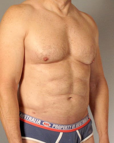 Abdominal Etching Before & After Gallery - Patient 413884 - Image 4
