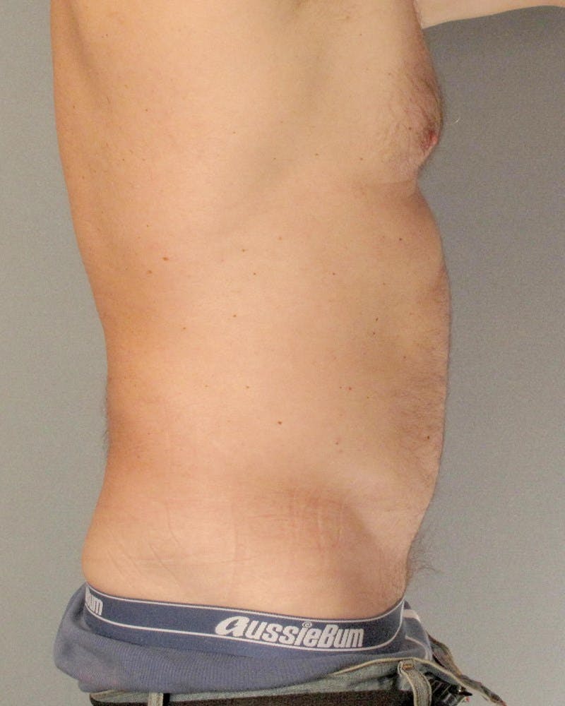 Abdominal Etching Before & After Gallery - Patient 413884 - Image 5