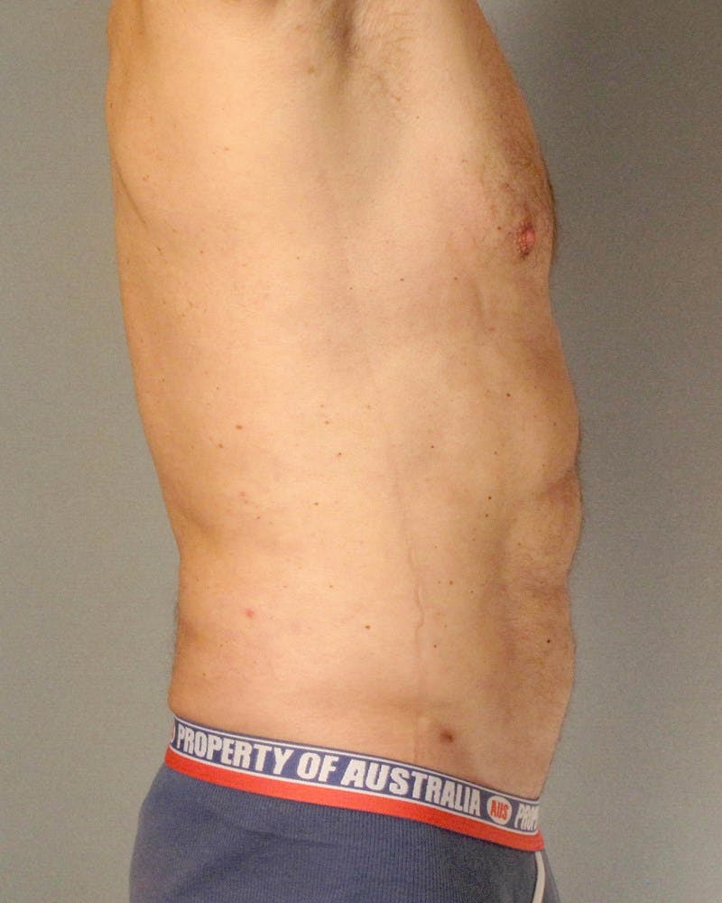 Abdominal Etching Before & After Gallery - Patient 413884 - Image 6