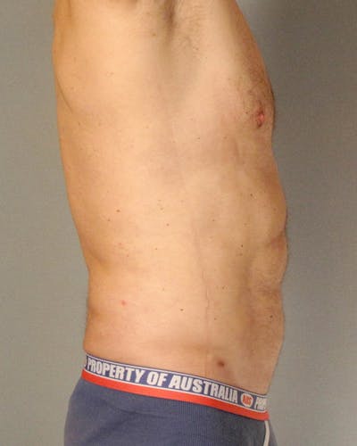 Abdominal Etching Before & After Gallery - Patient 413884 - Image 6