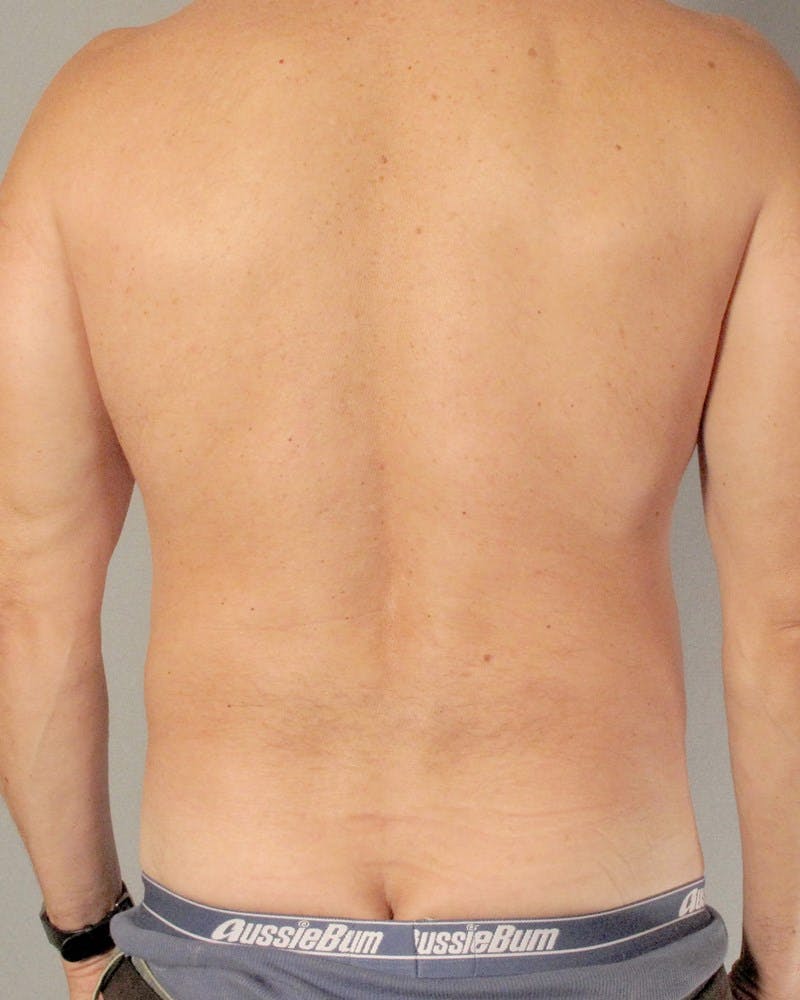 Abdominal Etching Before & After Gallery - Patient 413884 - Image 7