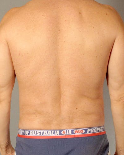 Abdominal Etching Before & After Gallery - Patient 413884 - Image 8