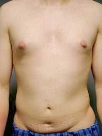 Abdominal Etching Before & After Gallery - Patient 191183 - Image 1