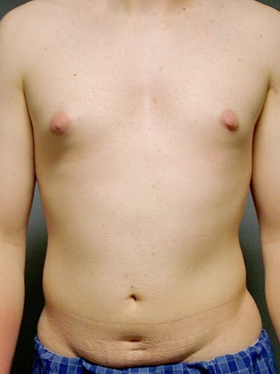 Abdominal Etching Before & After Gallery - Patient 191183 - Image 1