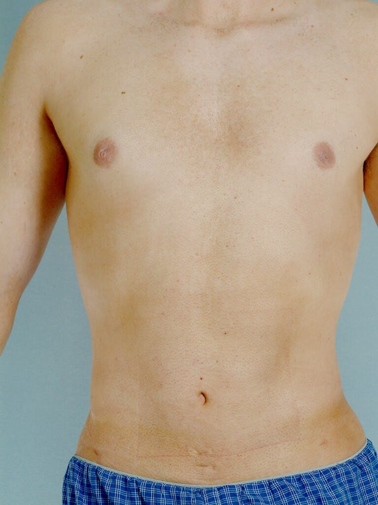Abdominal Etching Before & After Gallery - Patient 191183 - Image 2