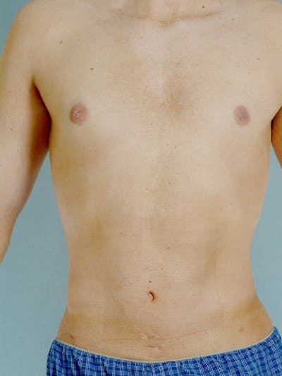 Abdominal Etching Before & After Gallery - Patient 191183 - Image 2