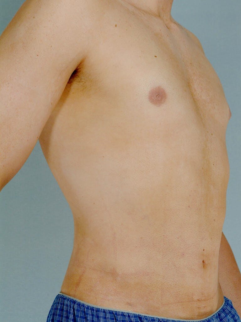 Abdominal Etching Before & After Gallery - Patient 191183 - Image 4