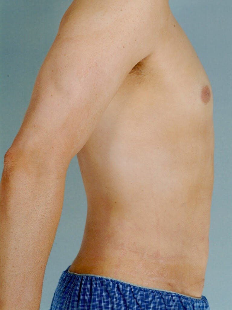 Abdominal Etching Before & After Gallery - Patient 191183 - Image 6