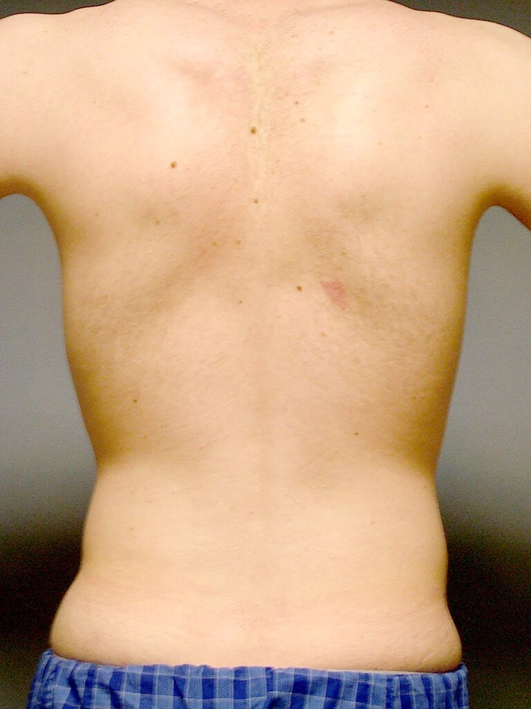 Abdominal Etching Before & After Gallery - Patient 191183 - Image 7