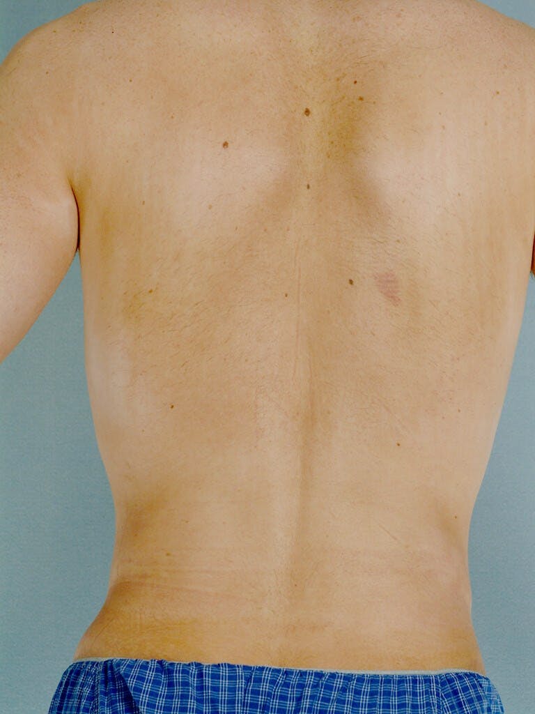 Abdominal Etching Before & After Gallery - Patient 191183 - Image 8