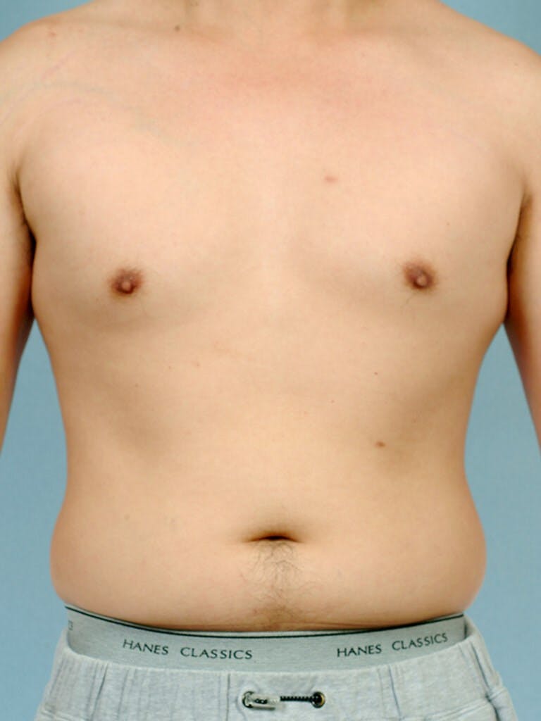 Abdominal Etching Before & After Gallery - Patient 253413 - Image 1