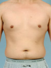 Abdominal Etching Before & After Gallery - Patient 253413 - Image 1