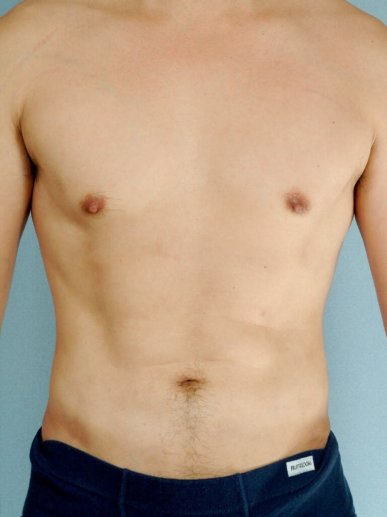 Abdominal Etching Before & After Gallery - Patient 253413 - Image 2