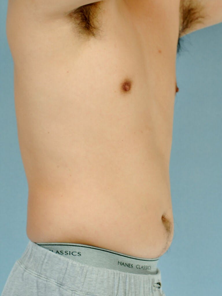Abdominal Etching Before & After Gallery - Patient 253413 - Image 3