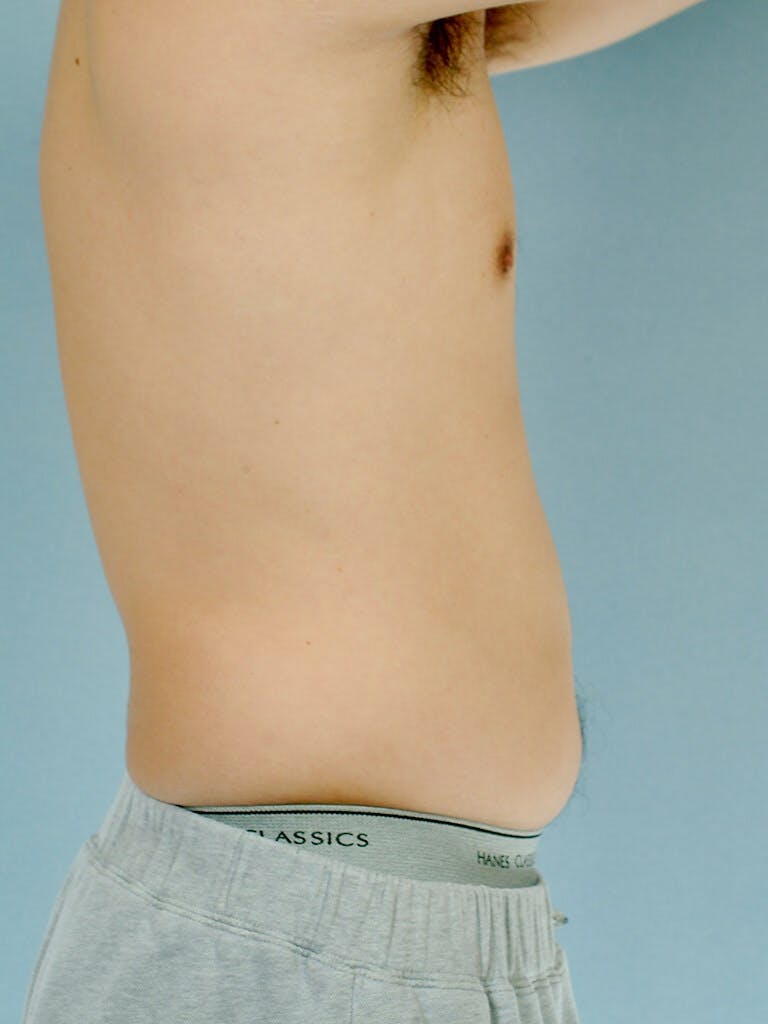 Abdominal Etching Before & After Gallery - Patient 253413 - Image 5