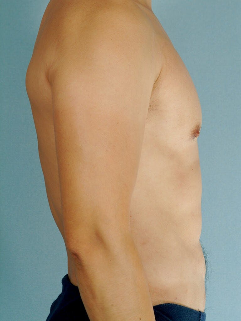 Abdominal Etching Before & After Gallery - Patient 253413 - Image 6