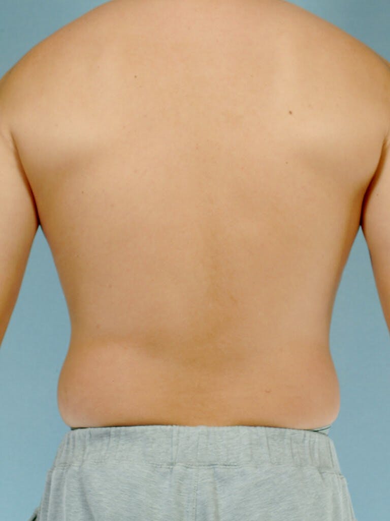 Abdominal Etching Before & After Gallery - Patient 253413 - Image 7