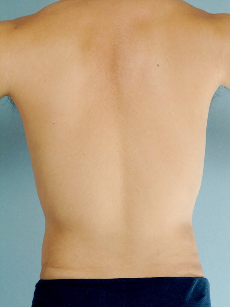 Abdominal Etching Before & After Gallery - Patient 253413 - Image 8