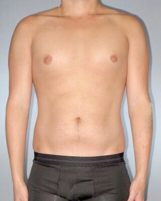 Abdominal Etching Before & After Gallery - Patient 155542 - Image 1