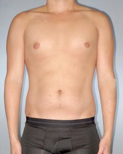 Abdominal Etching Before & After Gallery - Patient 155542 - Image 1