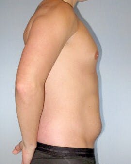 Abdominal Etching Before & After Gallery - Patient 155542 - Image 5