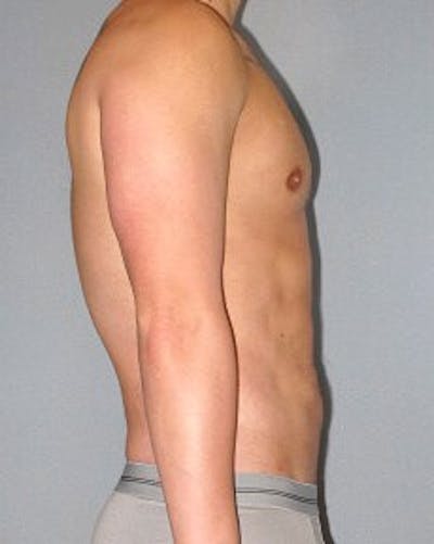 Abdominal Etching Before & After Gallery - Patient 155542 - Image 6