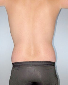 Abdominal Etching Before & After Gallery - Patient 155542 - Image 7