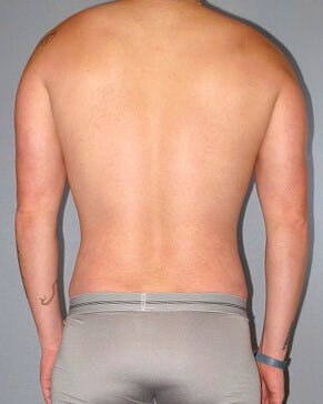 Abdominal Etching Before & After Gallery - Patient 155542 - Image 8