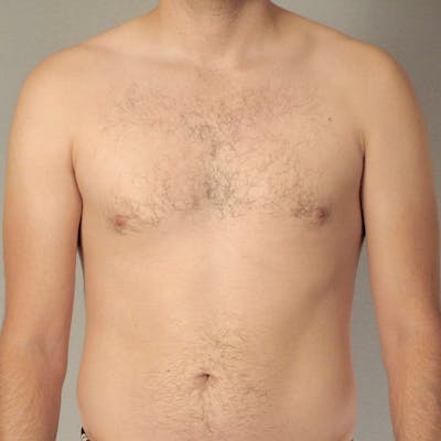 Abdominal Etching Before & After Gallery - Patient 199729 - Image 1