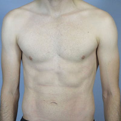 Abdominal Etching Before & After Gallery - Patient 199729 - Image 2