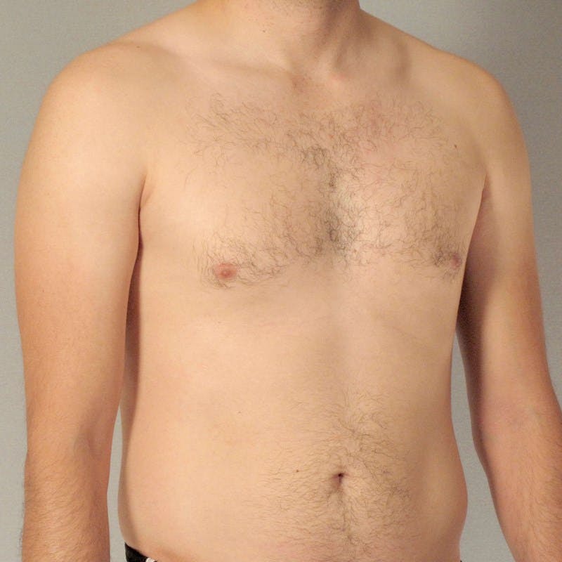 Abdominal Etching Before & After Gallery - Patient 199729 - Image 3
