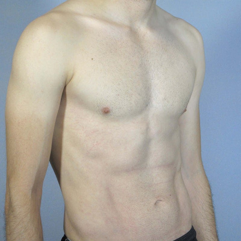 Abdominal Etching Before & After Gallery - Patient 199729 - Image 4