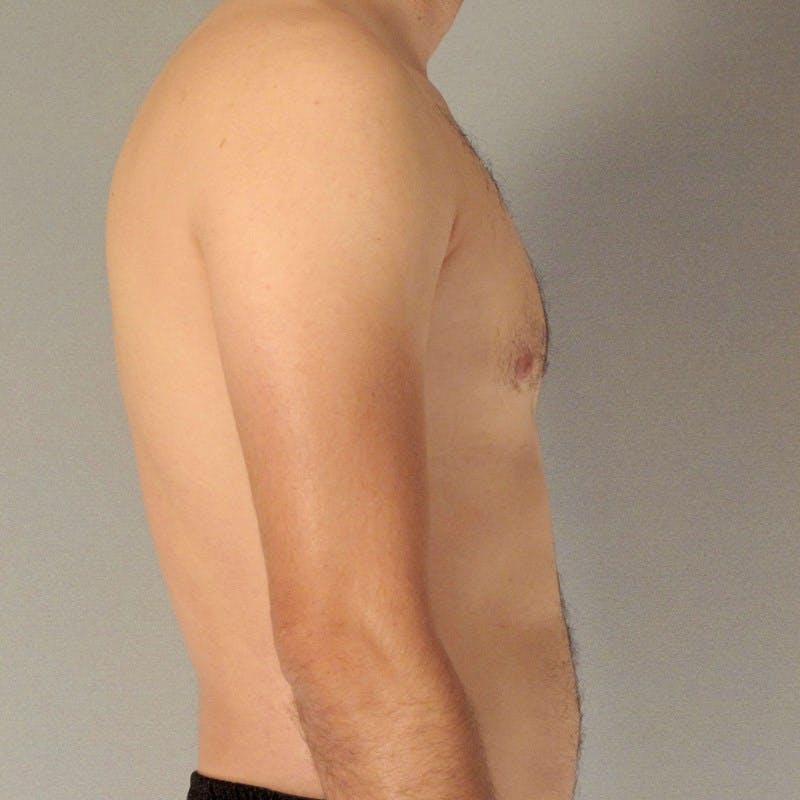 Abdominal Etching Before & After Gallery - Patient 199729 - Image 5